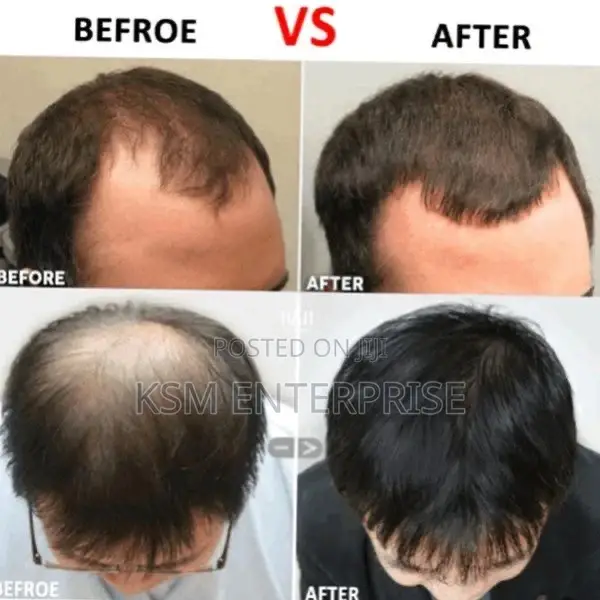 Derma Roller