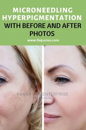 Derma 0.5mm Roller System