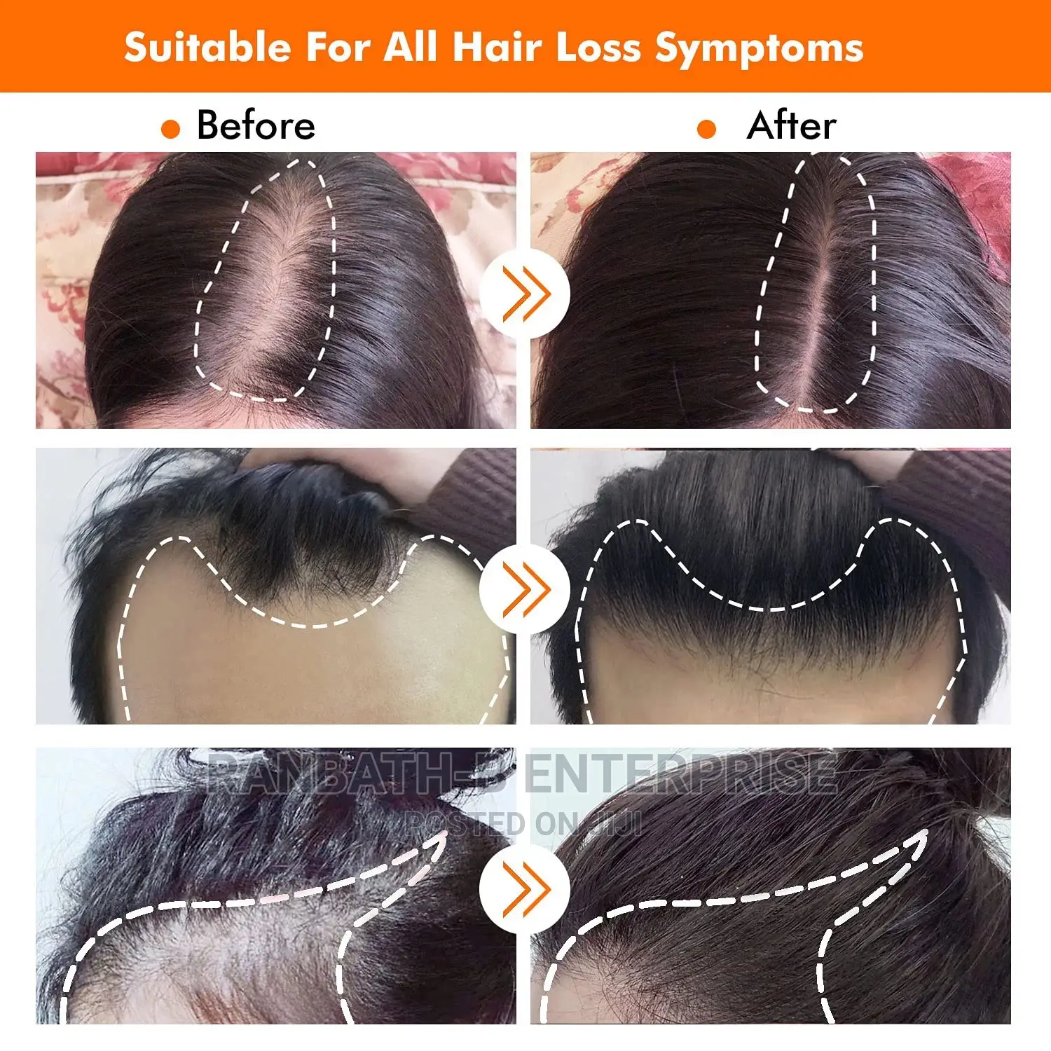Derma Hair Roller System (0.5mm)