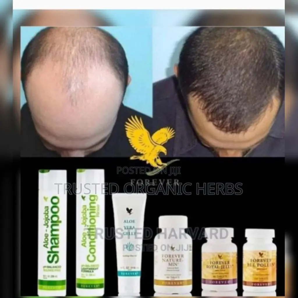 Baldness Or Hair Loss