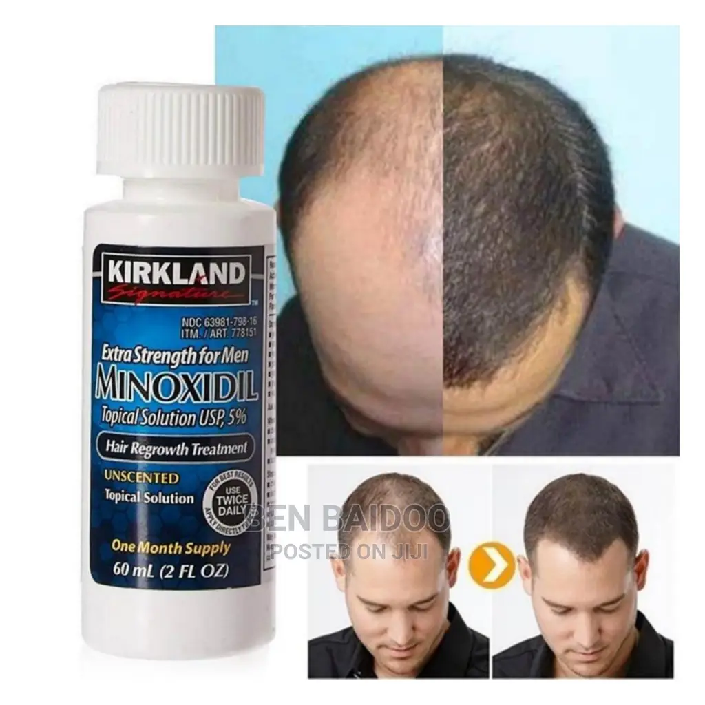 Kirkland Hair Regrowth (Treat Baldness)