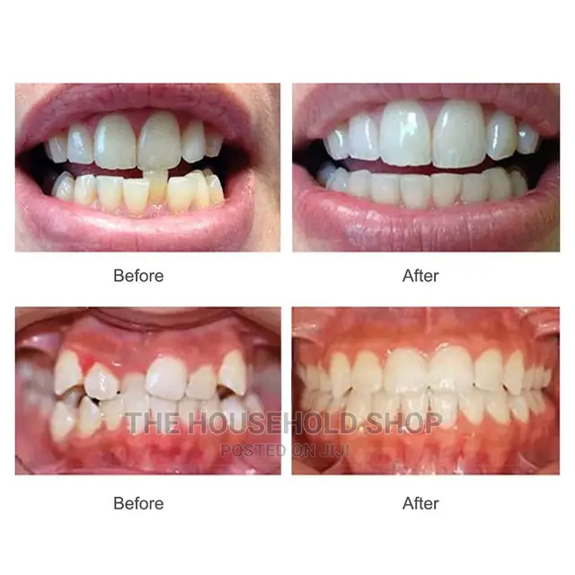3 Stage Teeth Corrector Device/ Braces/ Aligners