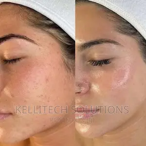 Derma Roller (0.5mm, 540needles) Promo