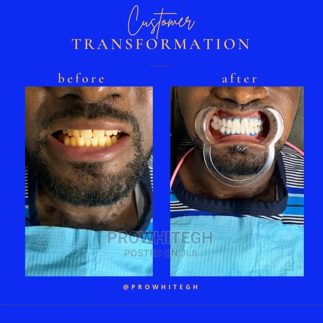 Instant Teethwhitening Service