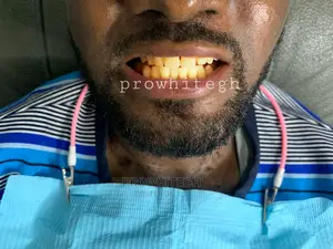 Instant Teethwhitening Service