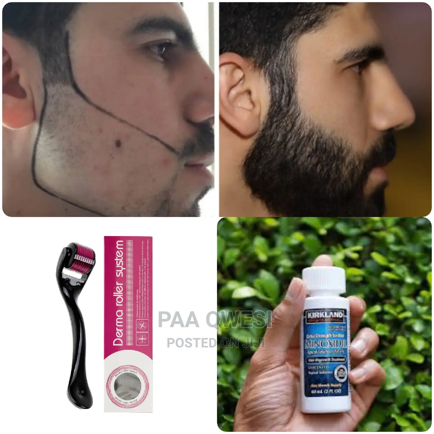 Minoxidil / Derma Roller
