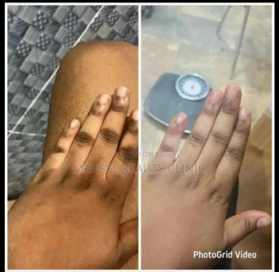 Tca Chemical Peel Solution