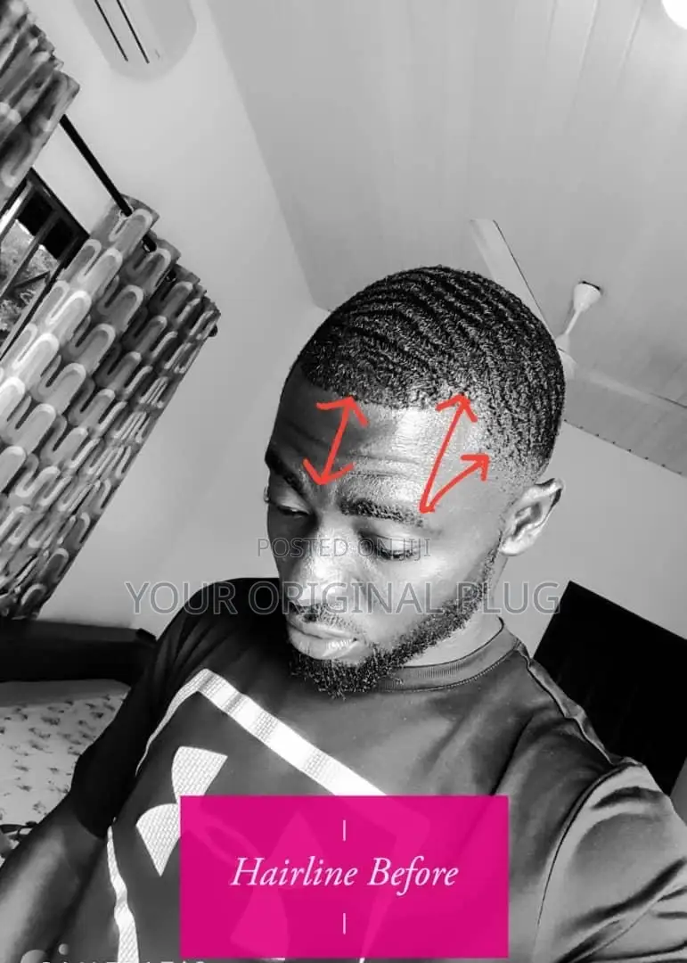 Kirkland Minoxidil + Derma Roller (Best Combo)