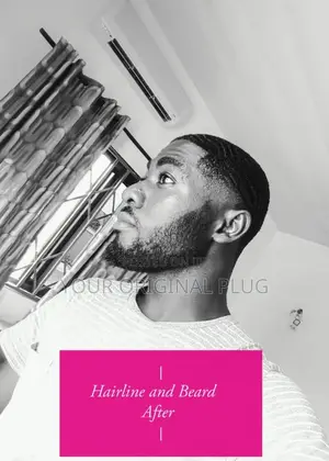 Kirkland Minoxidil + Derma Roller (Best Combo)