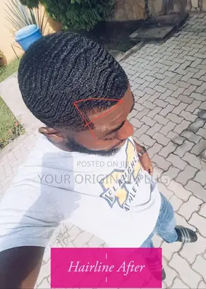 Kirkland Minoxidil + Derma Roller (Best Combo)