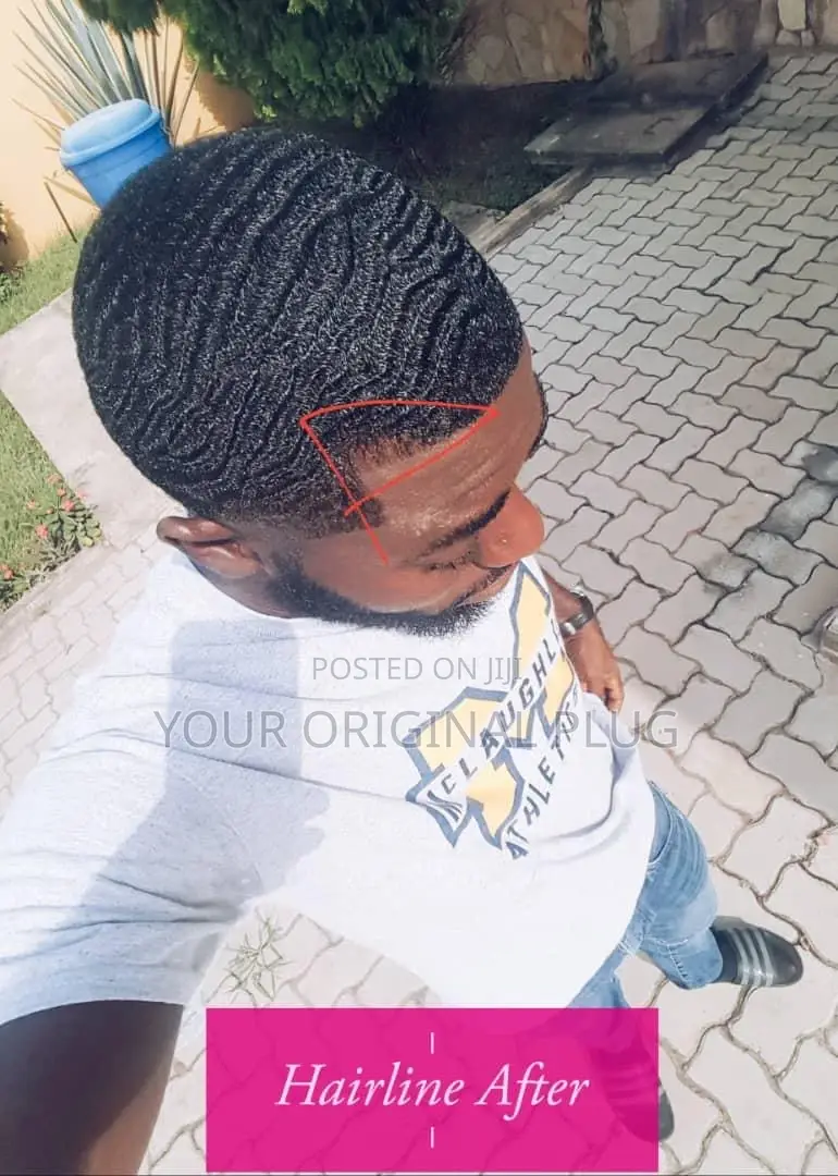 Kirkland Minoxidil + Derma Roller (Best Combo)