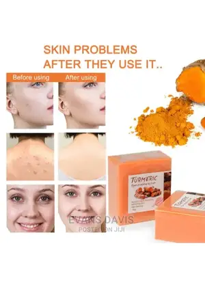 Tumeric Acne, Sunburns and Dark Spot Remover Soap