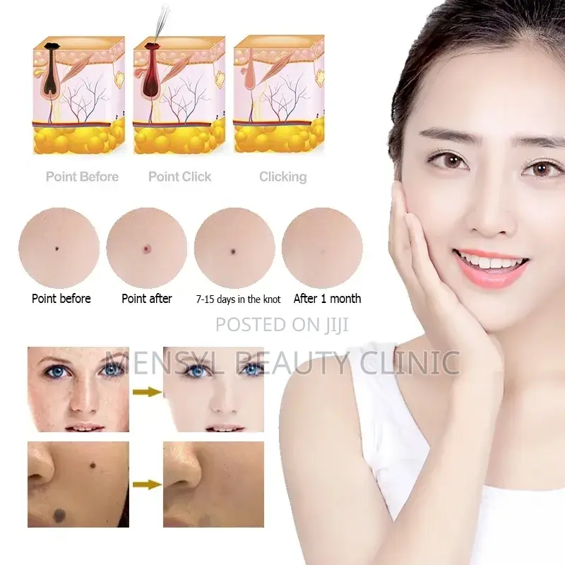Plasma Pen for Skin Tag Removal,Stretch Marks and Tightening