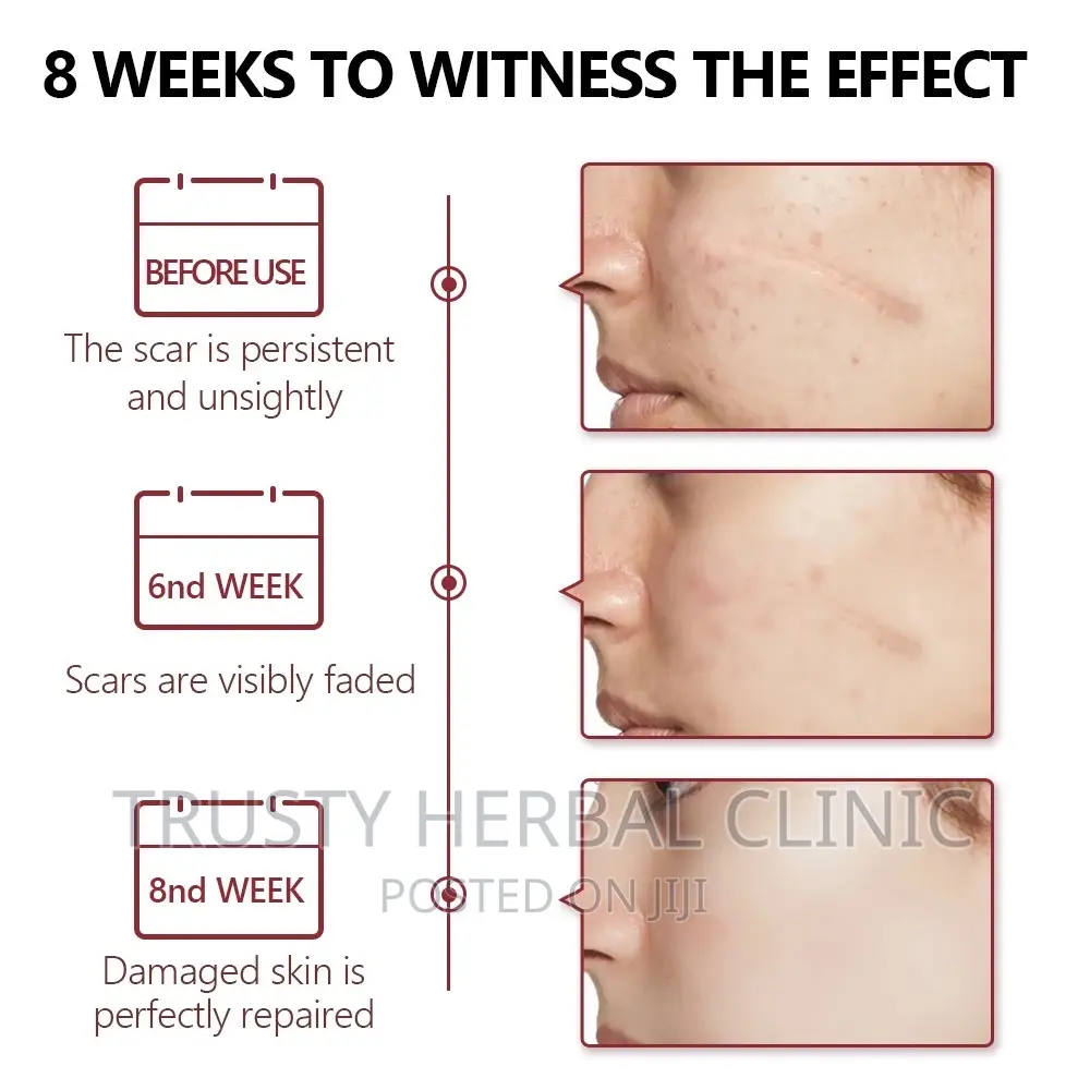 Vibrant Glamour Crocodile Scar Removal Acne Repair Solution