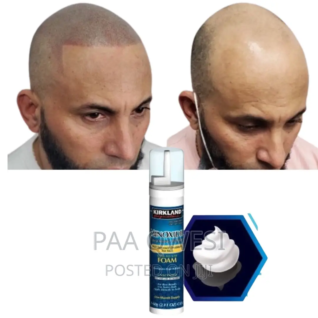 Super Fast Hairline Regrowth