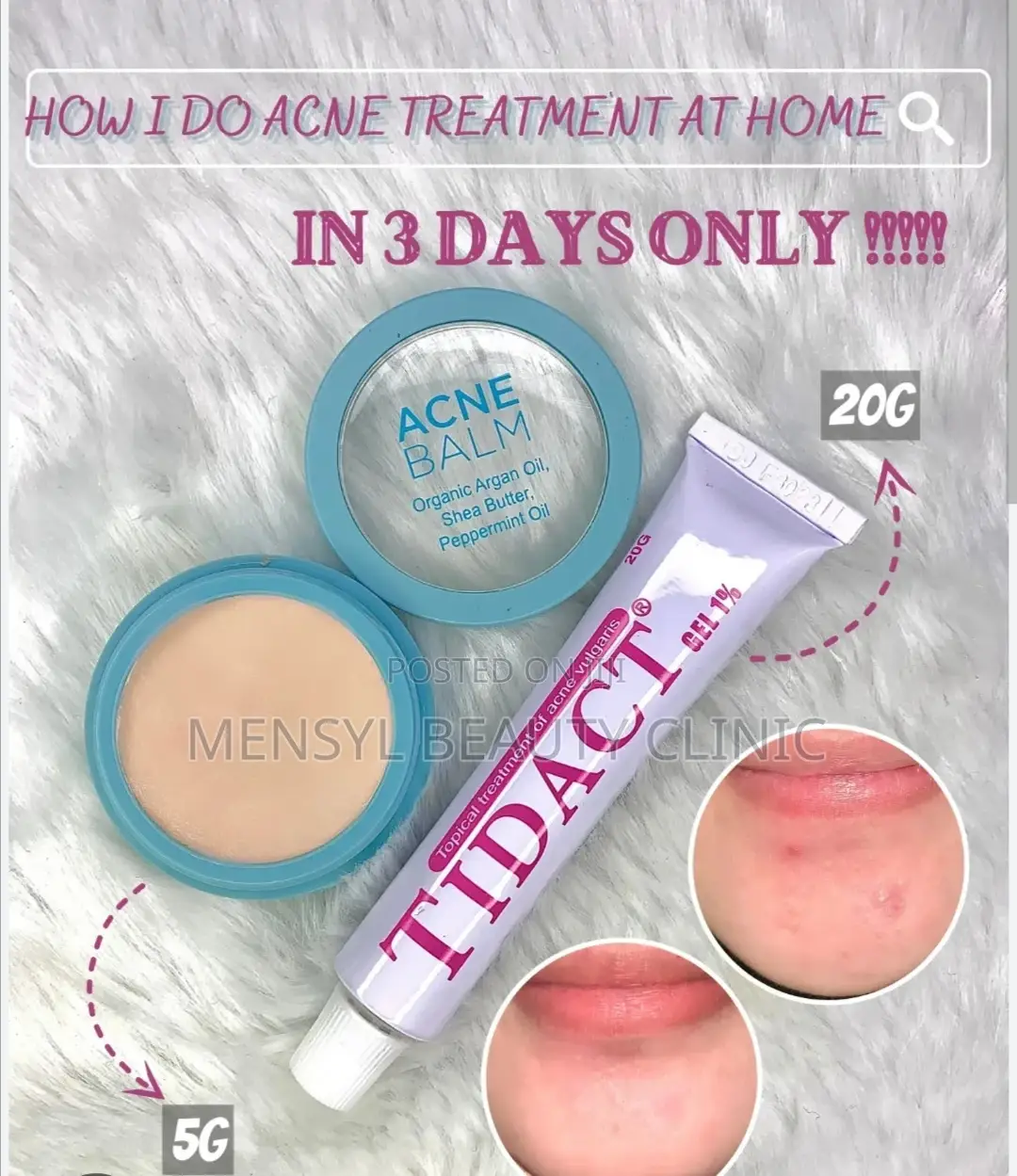 Tidact Gel 1% PH Balanced Anti Acne Anti Pimple