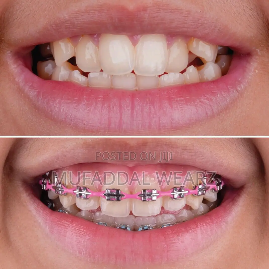 Perfect Your Smile With Braces and Aligners
