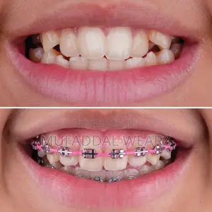 Perfect Your Smile With Braces and Aligners