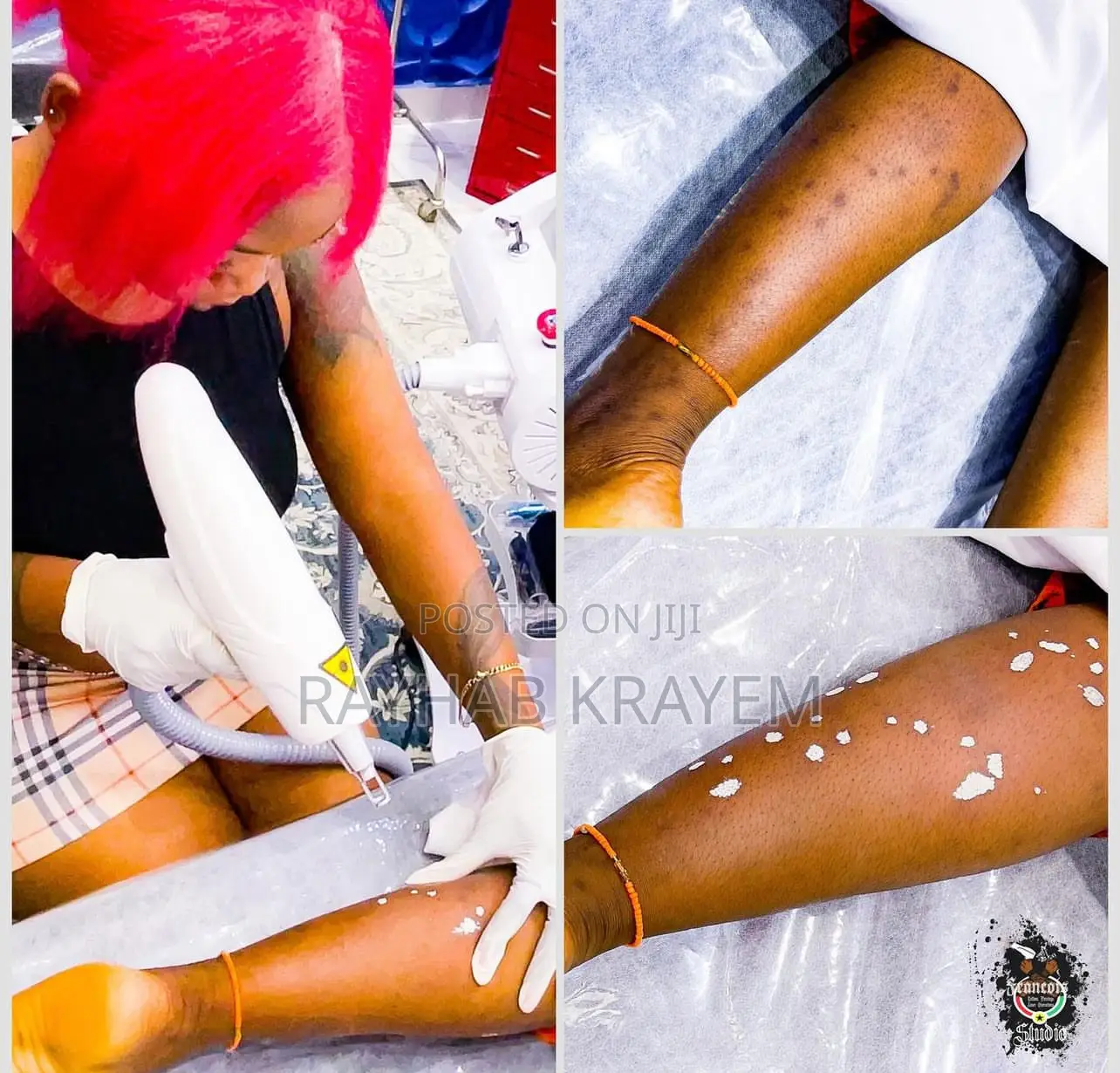 Laser Skincare Treatments (Get Rid Of Anything On Your Skin)