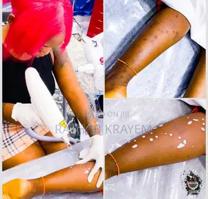 Laser Skincare Treatments (Get Rid Of Anything On Your Skin)