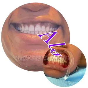 Laser Teeth Whitening