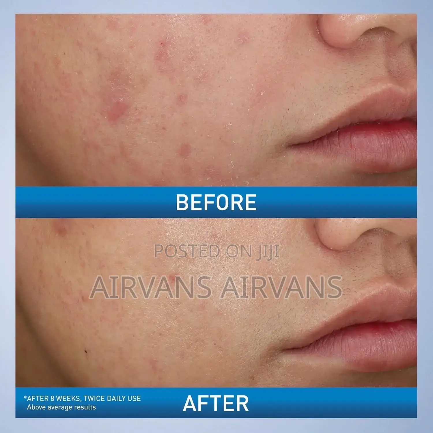 Cerave Acne Foaming Cream Wash