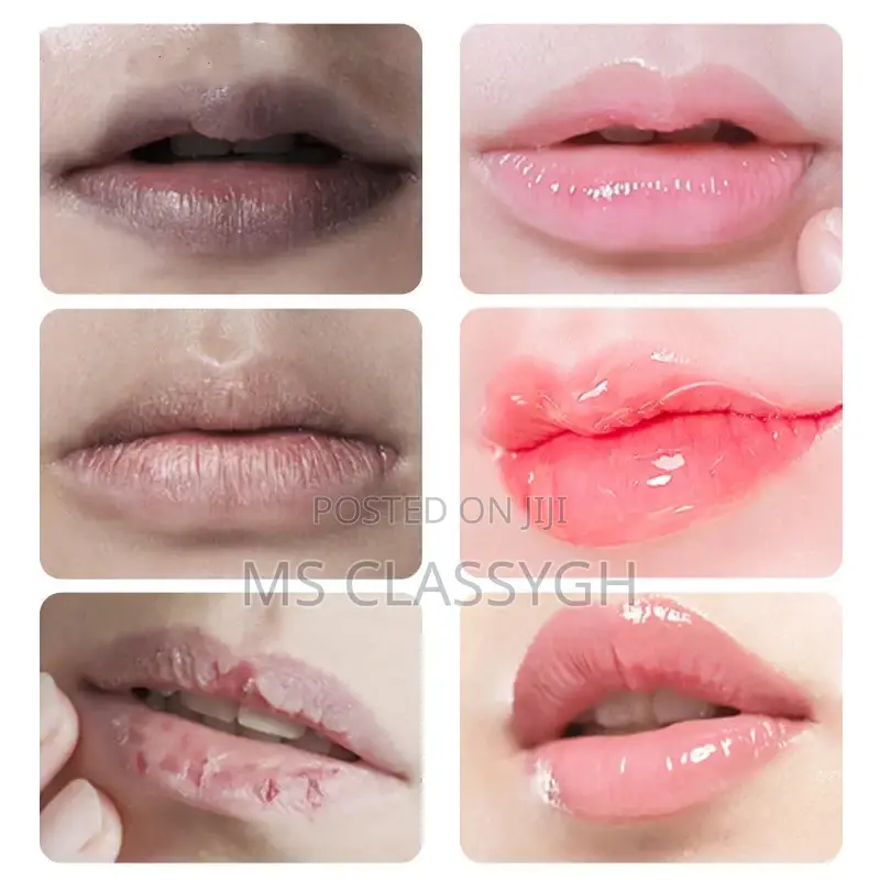 Black Lip Removal Pigmentation Fade Dull Pink Lip Balm Brigh