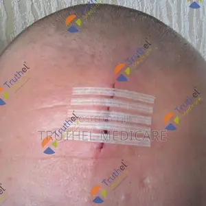 Steri Strips - Skin Closure