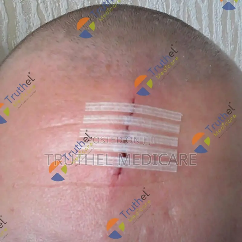 Steri Strips - Skin Closure