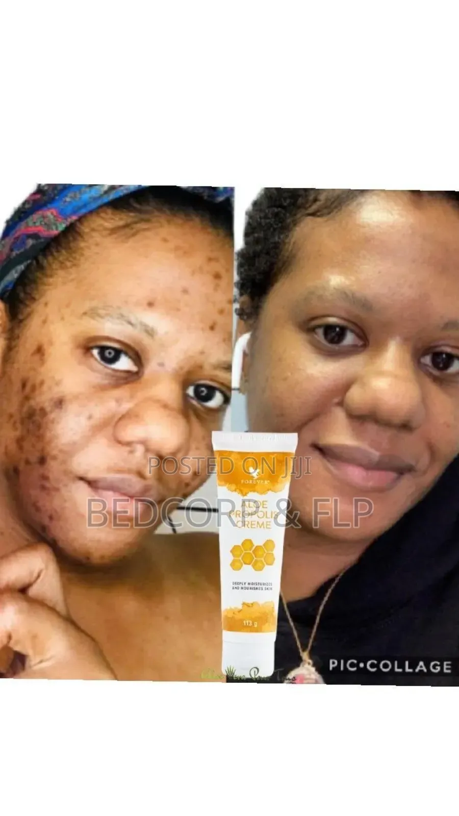 Forever Propolis Creme for Discoloration