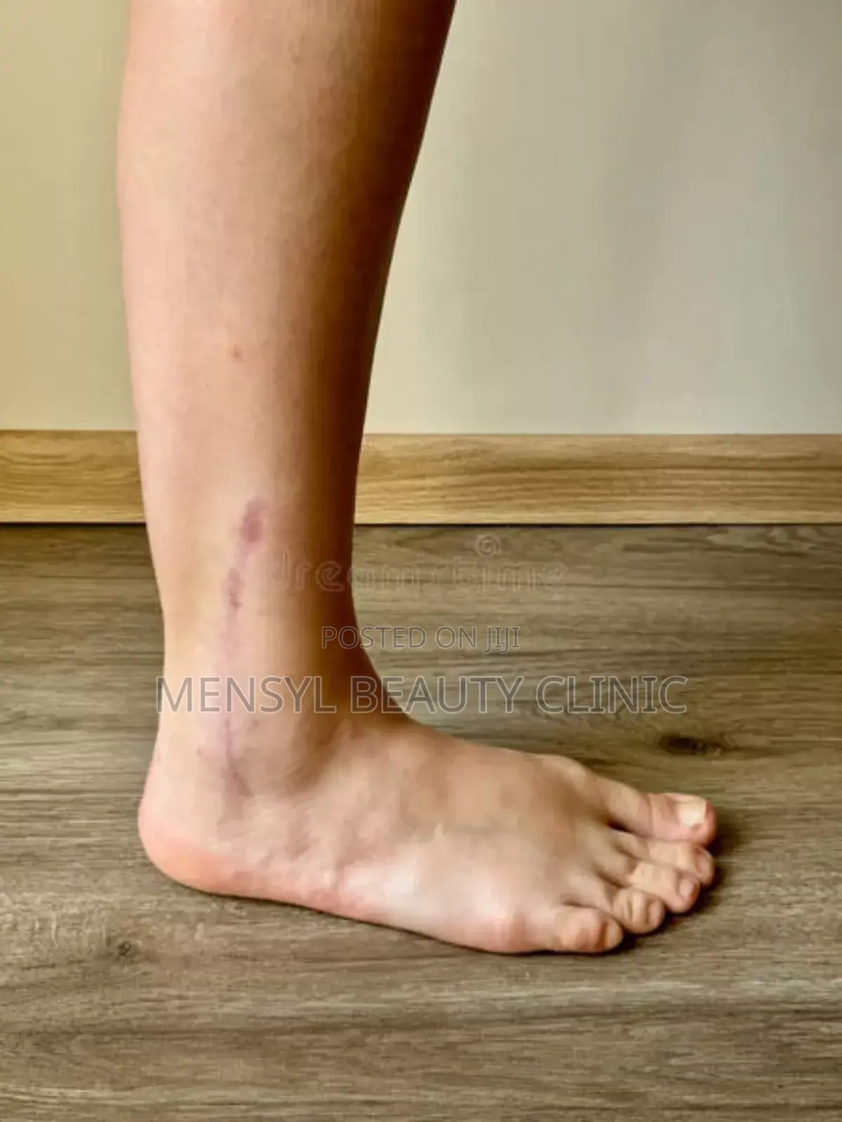 Silicone Scar Gel for All Type of Scar Including Keloid