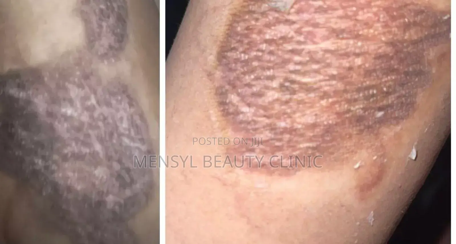Silicone Scar Gel for All Type of Scar Including Keloid
