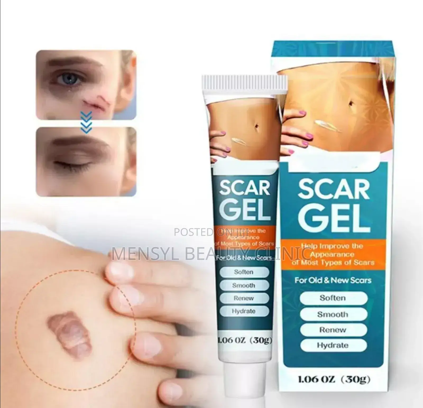 Silicone Scar Gel for All Type of Scar Including Keloid