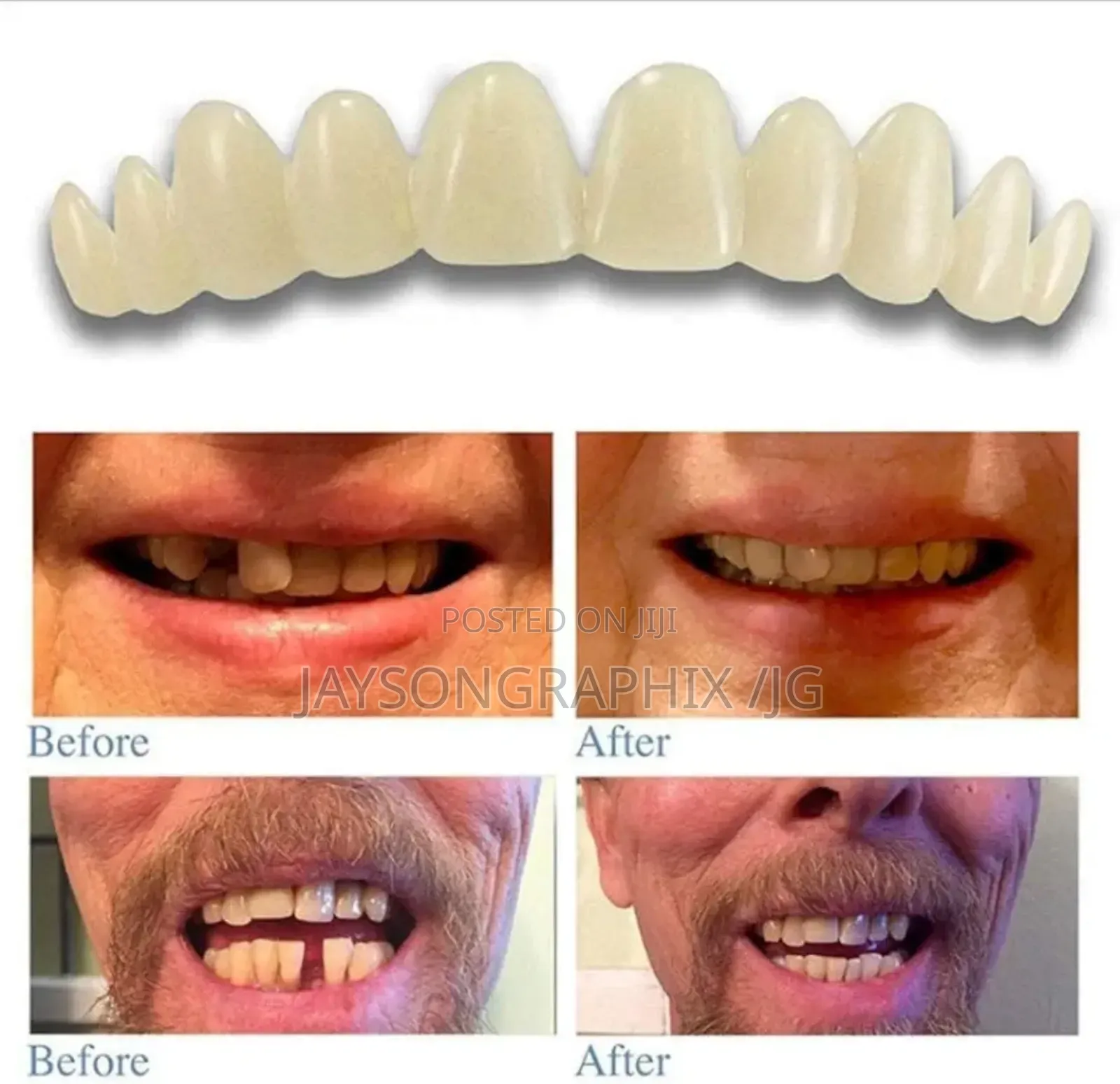 Instant Smile Temporary Tooth Kit