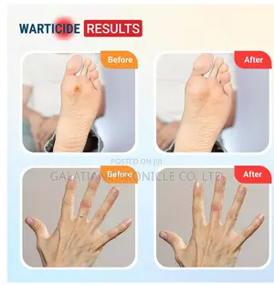 Warticide Wart Remover