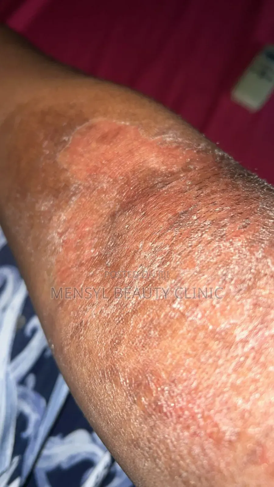 Chemical Peel Gly-Colagen Peeling Solution for Radiant Skin