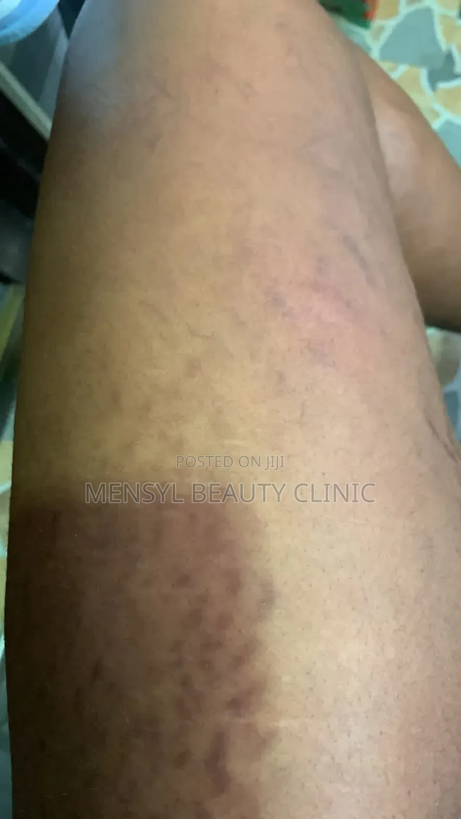 Chemical Peel Gly-Colagen Peeling Solution for Radiant Skin