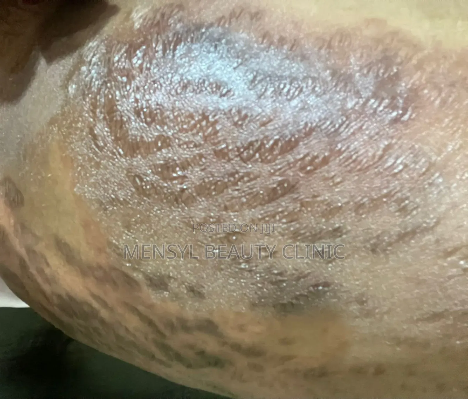 Chemical Peel Gly-Colagen Peeling Solution for Radiant Skin