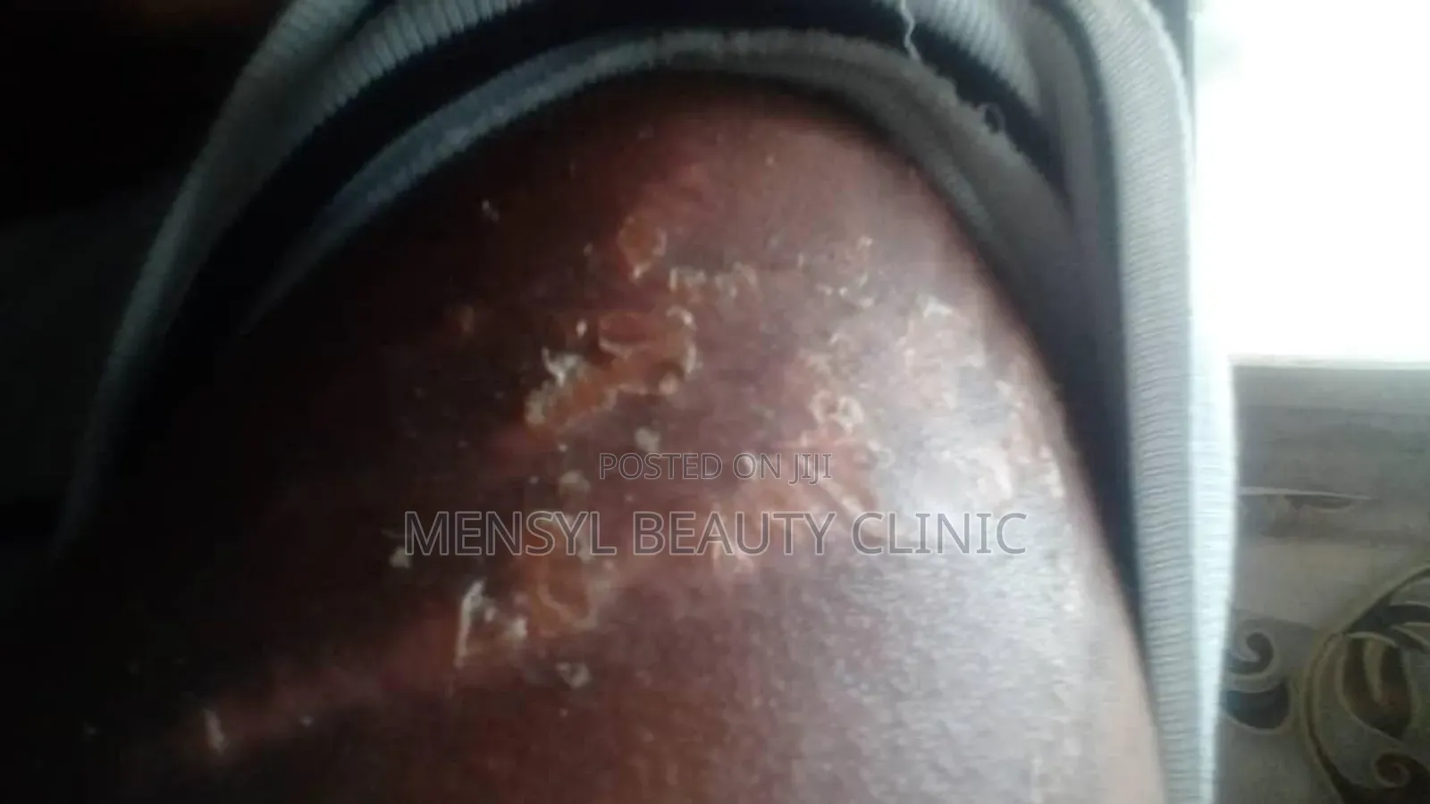 Chemical Peel Gly-Colagen Peeling Solution for Radiant Skin