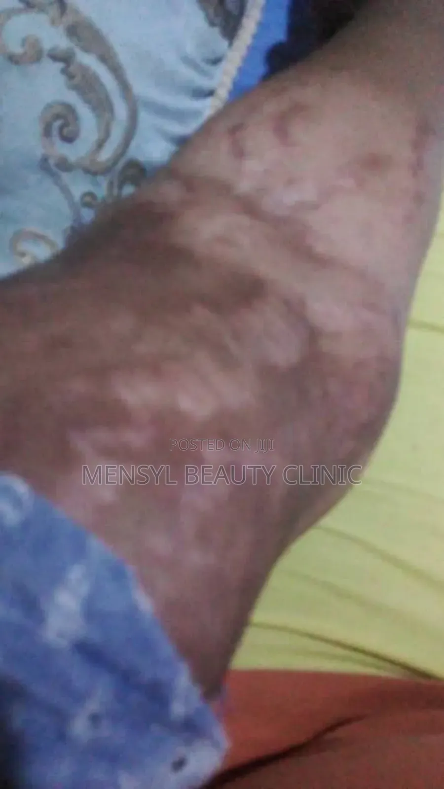 Chemical Peel Gly-Colagen Peeling Solution for Radiant Skin