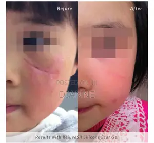 Most Effective Silicone Scar Gel in Ghana