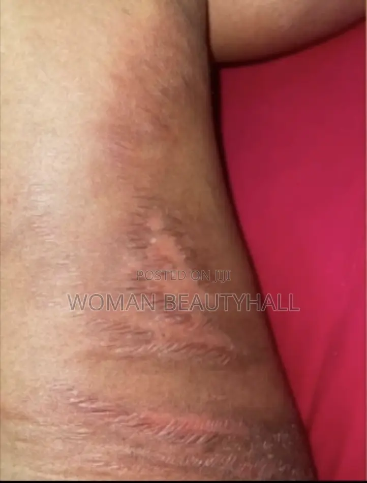 Laser Stretch Marks Treatment