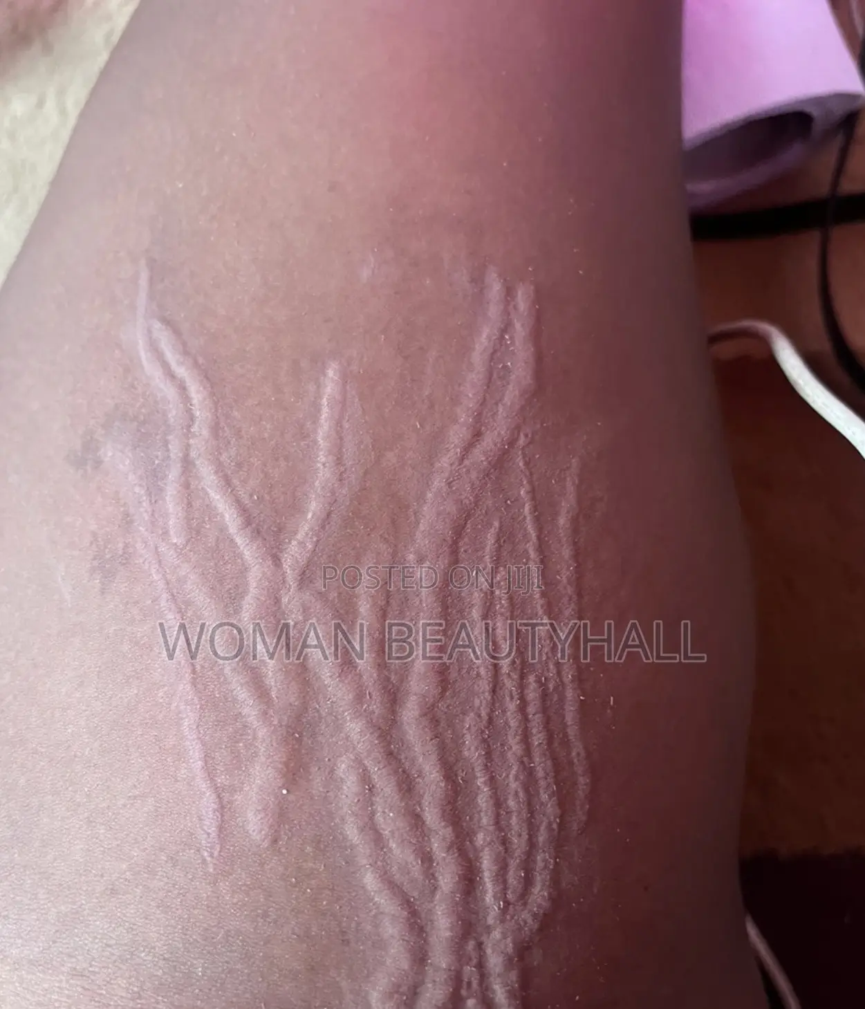Laser Stretch Marks Treatment