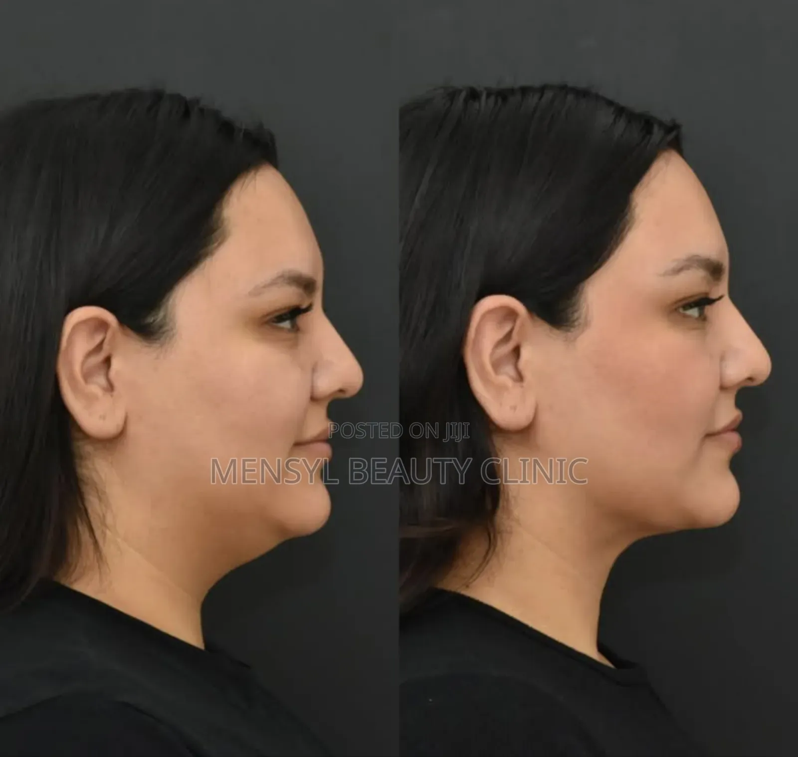 Korea Venus Slim 6d Fat Dissolving Injection for Face