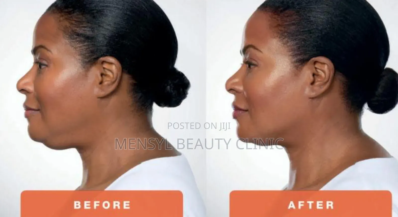 Korea Venus Slim 6d Fat Dissolving Injection for Face