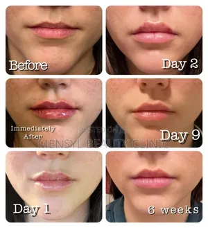 Bellast Ha Facial Filler Is Korean Dermal Fillers for Face