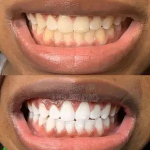 Teeth Whitening Kit