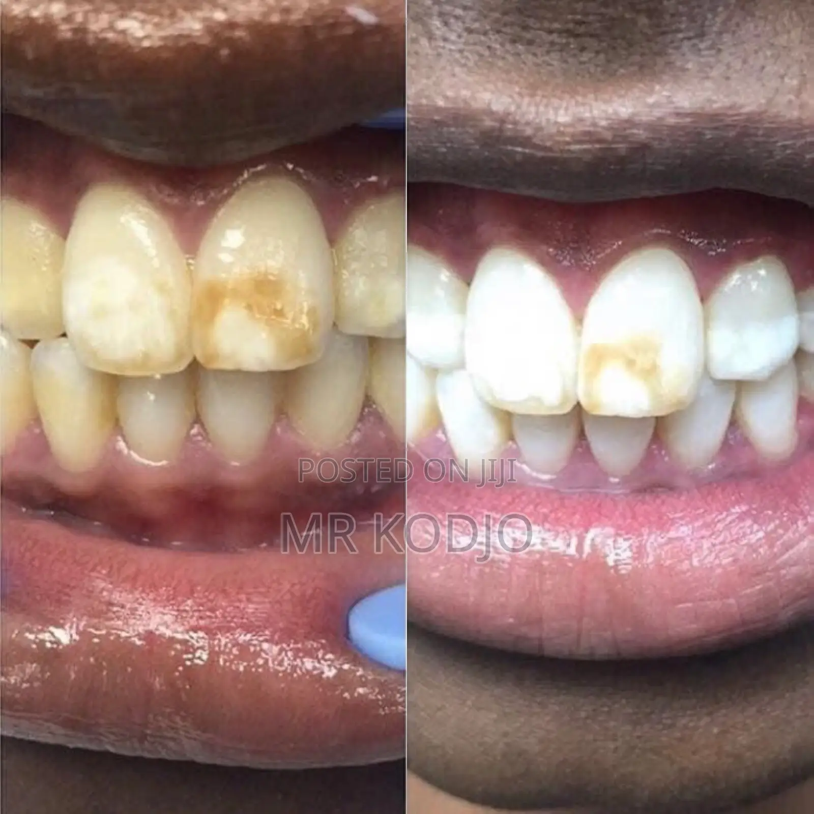Teeth Whitening Kit