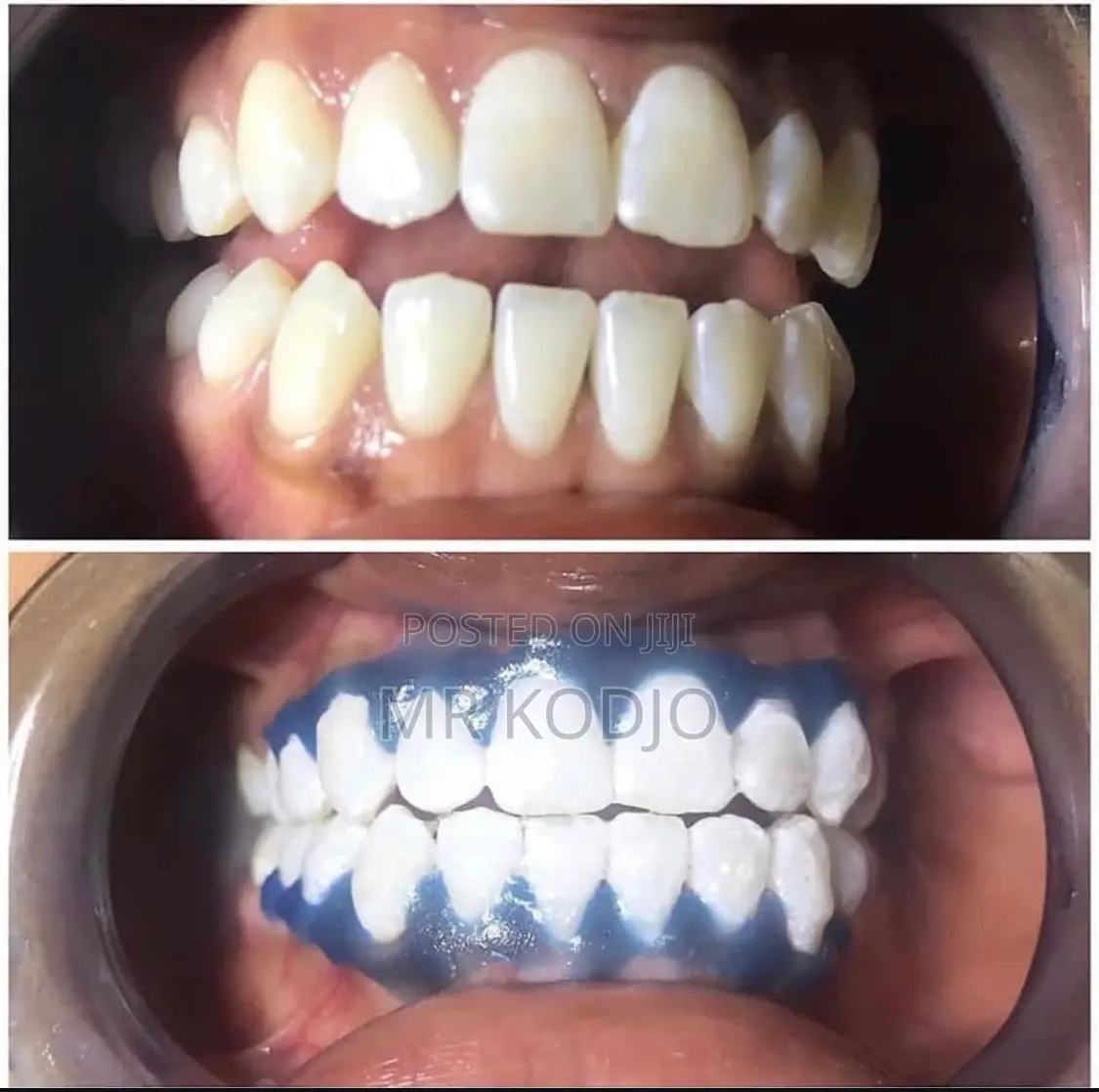 Teeth Whitening Service