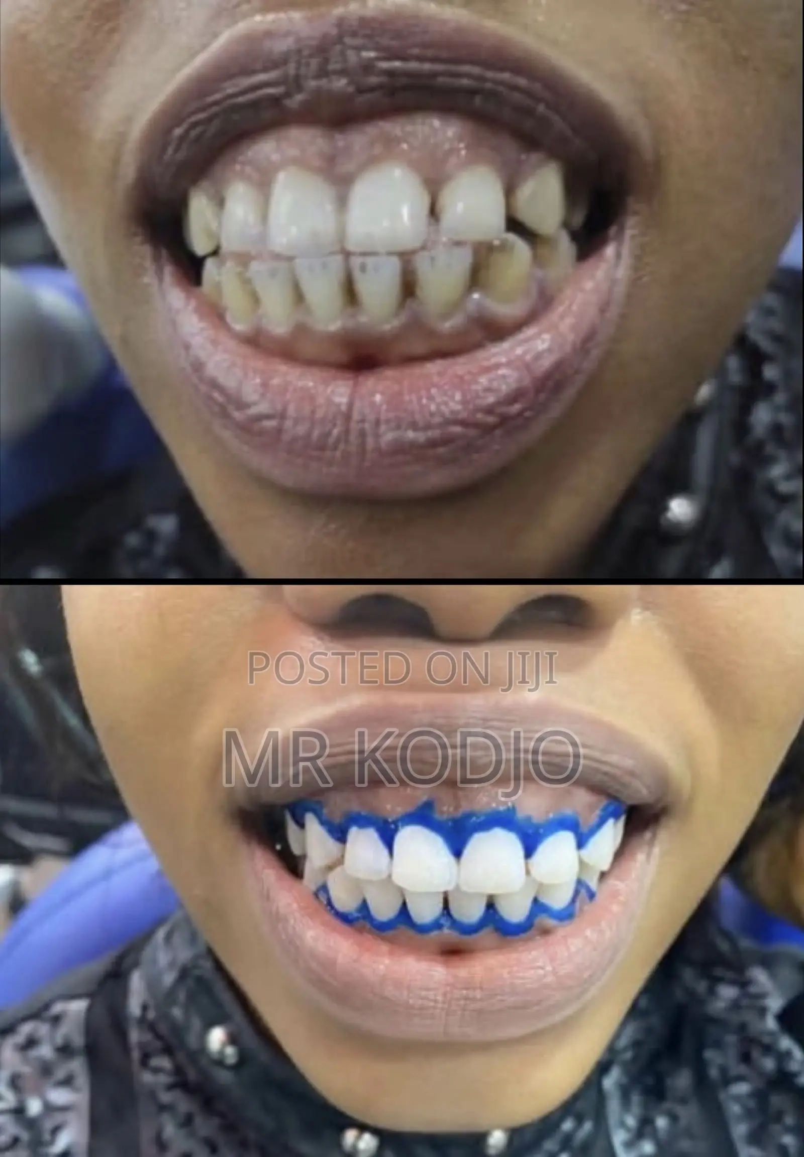 Teeth Whitening Service